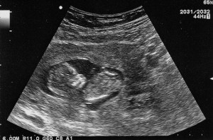 12 Week Scan - One